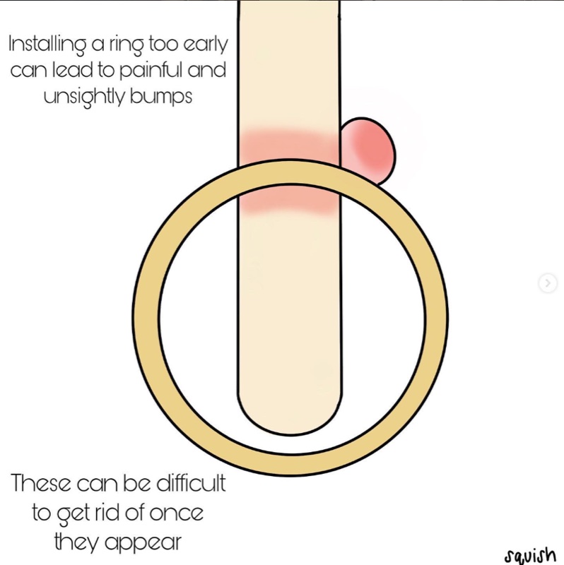 Installing a ring too early can lead to painful and unsightly bumps that can be difficult to get rid of once they appear